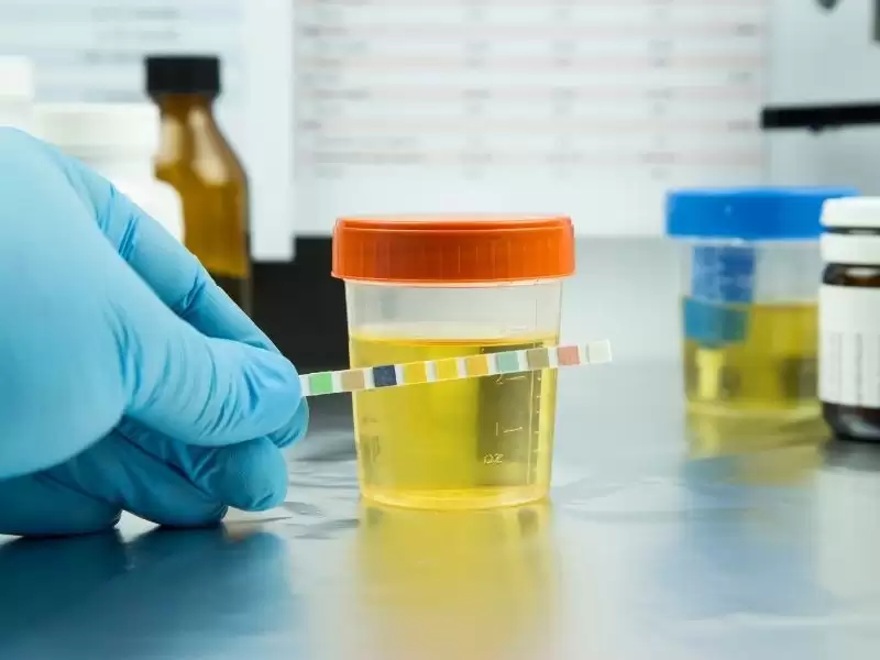 idrar-testlerinde-kan-protein-lokosit-gorulmesi